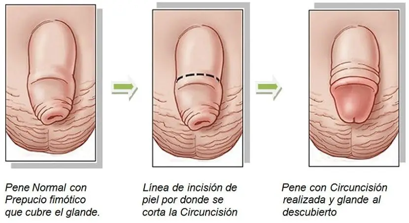 Minet para el aumento del miembro